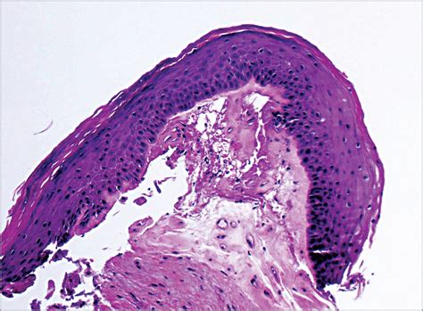 lichen sclerosus genitalis|lichen sclerosus et atrophicus genital.